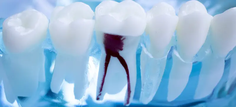 Dental model showing tooth root canal